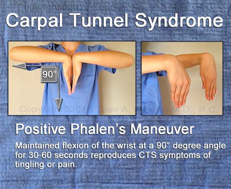 Associated with carpal tunnel syndrome, median nerve compression beneath the volar carpal ligament. Pahlen's sign is elicited with forced flexion of the wrist for at least 30 seconds resulting in...